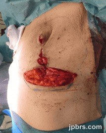 Closure of vertical incisions