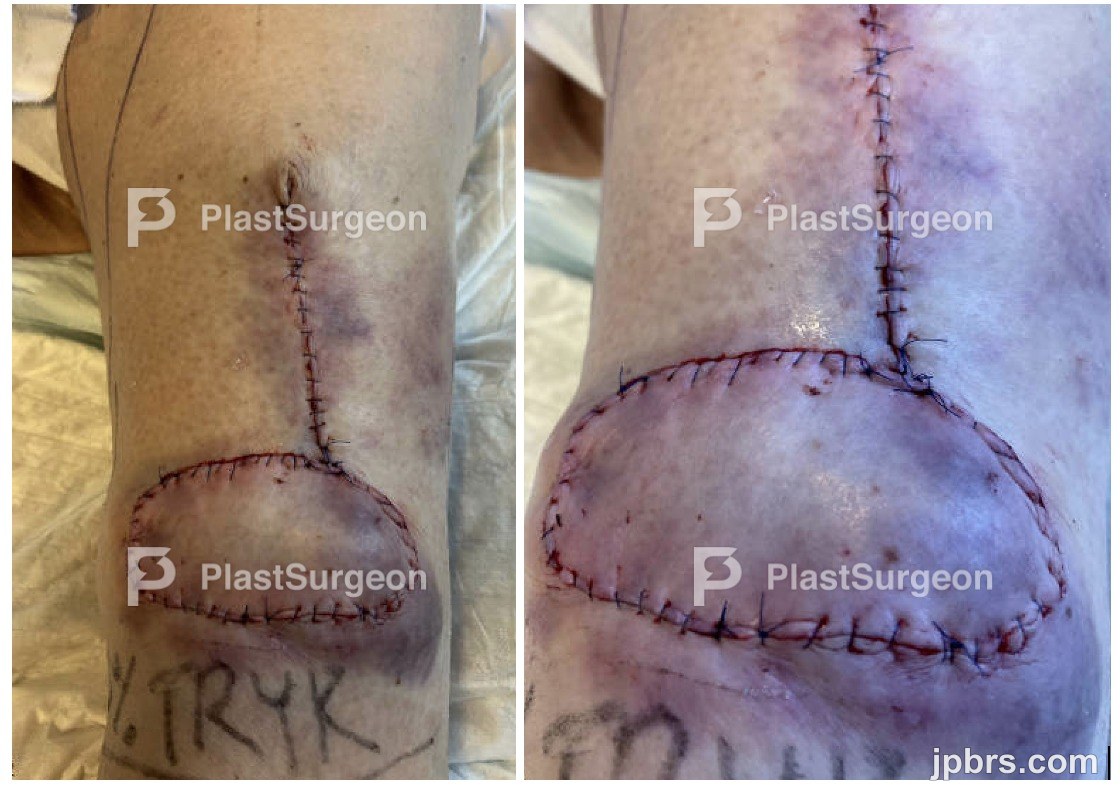 Reconstructive method