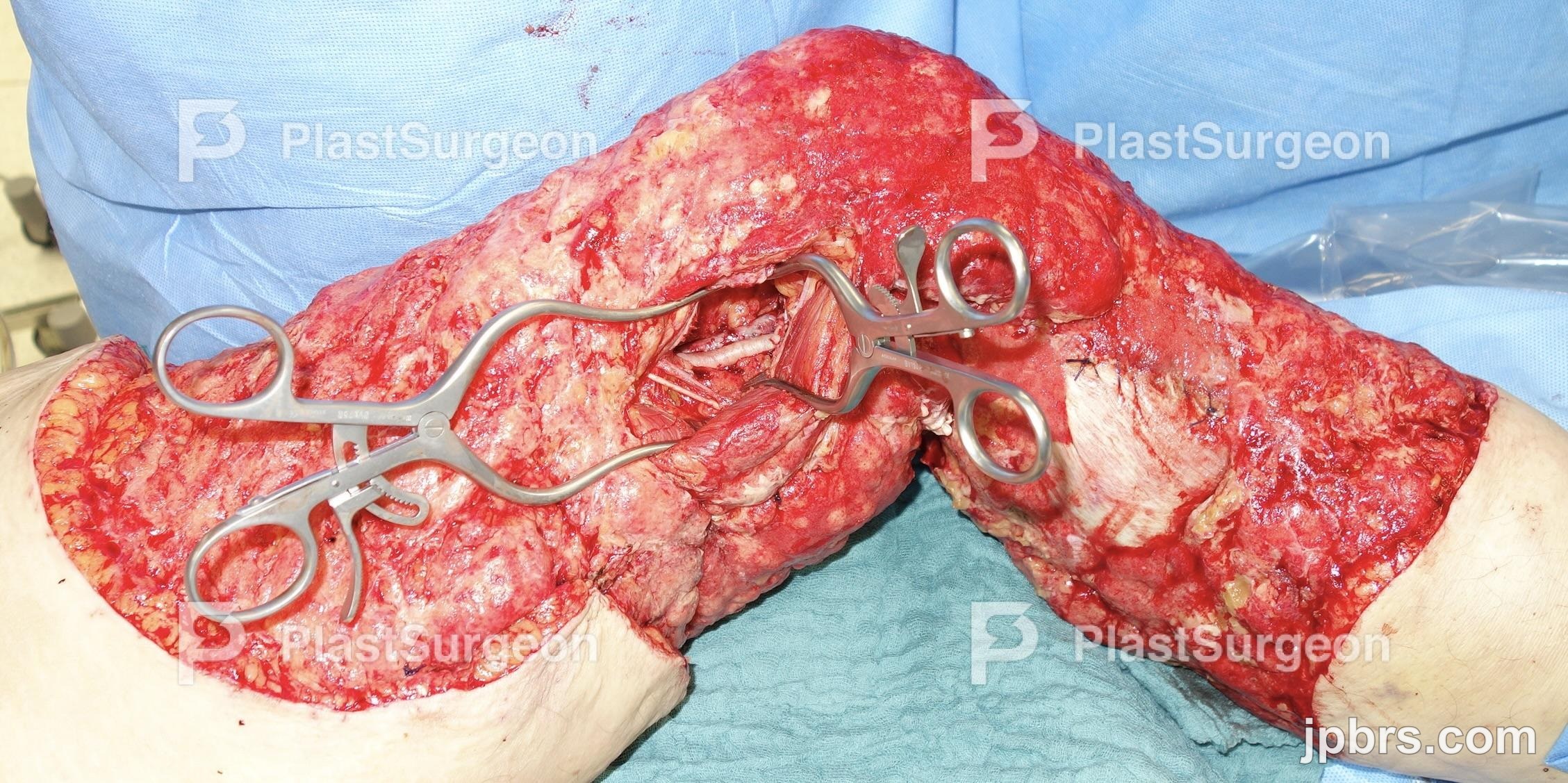 Ischemic preconditioning