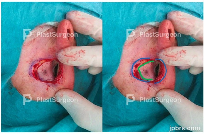 1.stage Suture