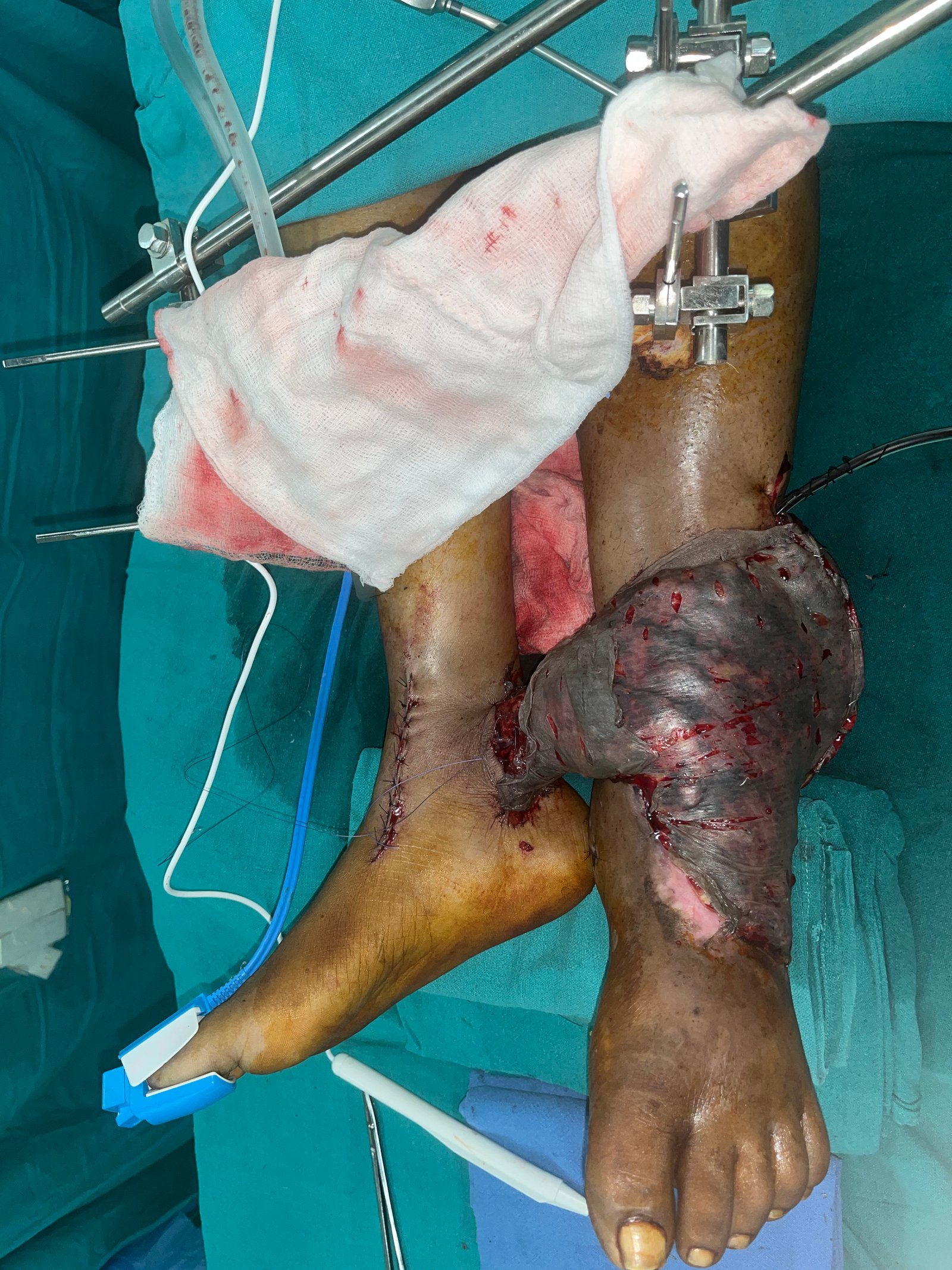 Cross leg Free latissimus dorsi muscle flap with split skin graft and limb fixed with external fixator