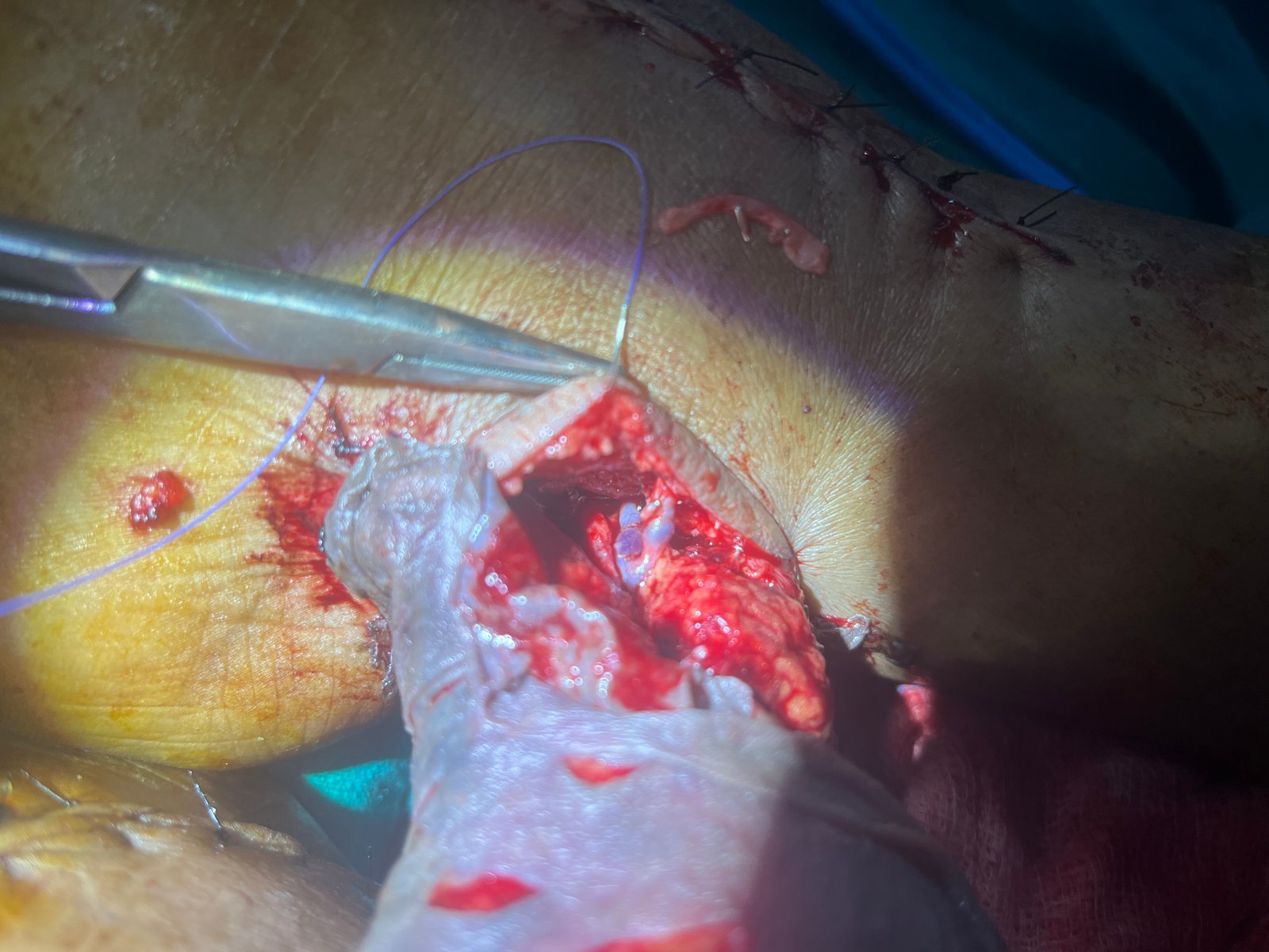 ETE Anastomoses of the thoracodorsal vein to the vena comitantes and ETS anastomoses of the GSV to the thoracodorsal vein
