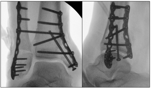 Radical wound bed preparation and hardware assessment
