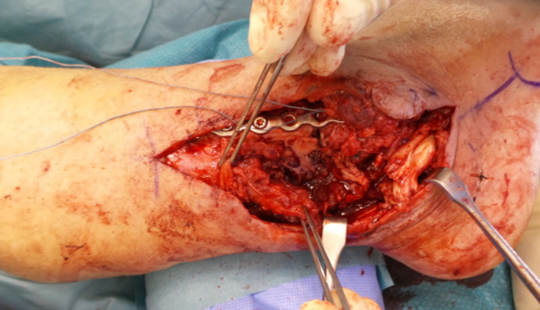 Preparation of the recipient site