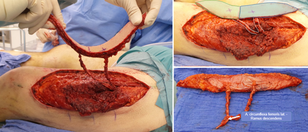 Flap dissection