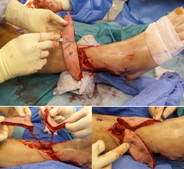Microsurgical anastomoses and flap splitting