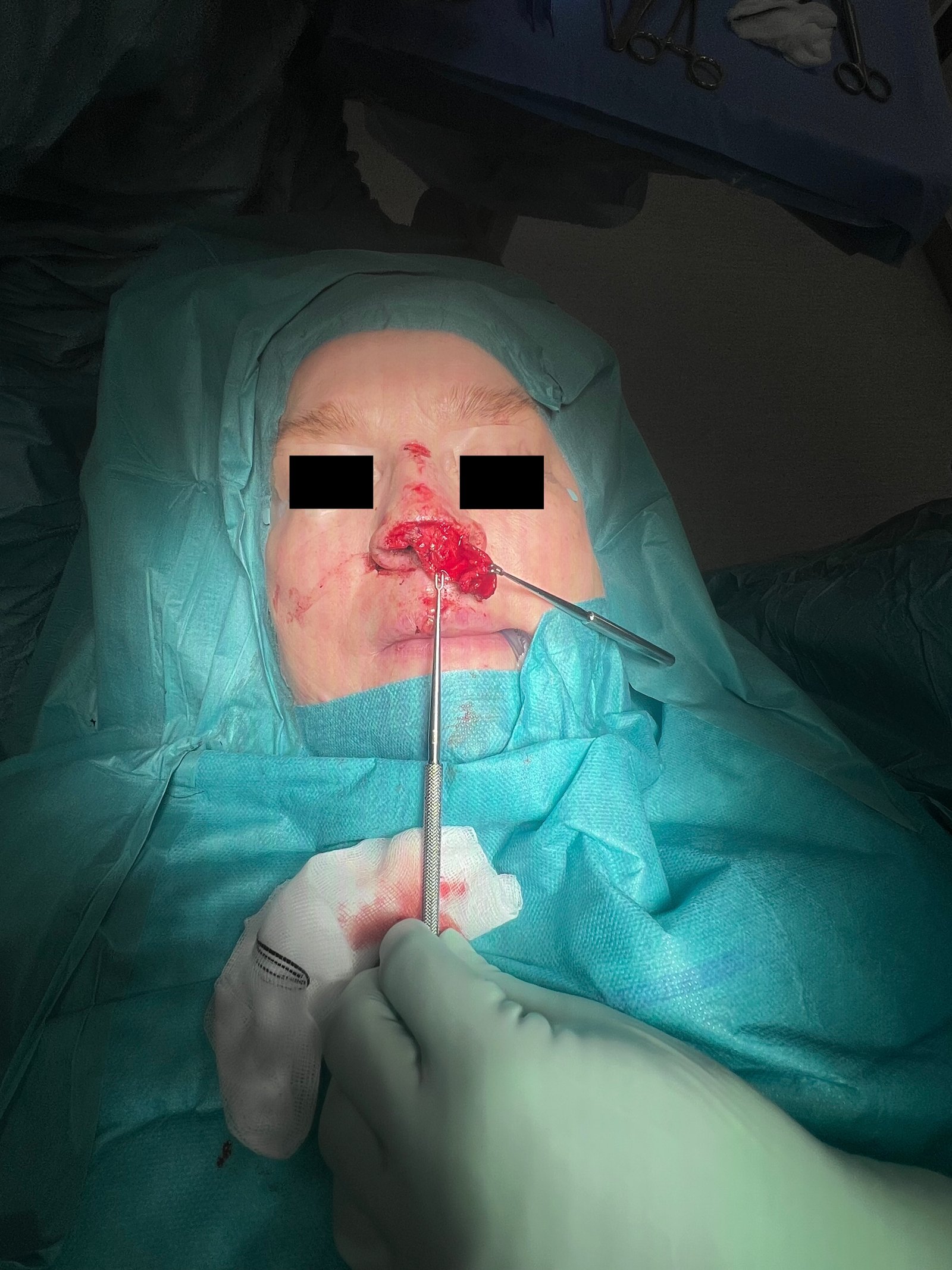 Exposure of the cartilage