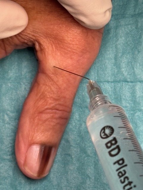 Skin antisepsis and digital nerve block