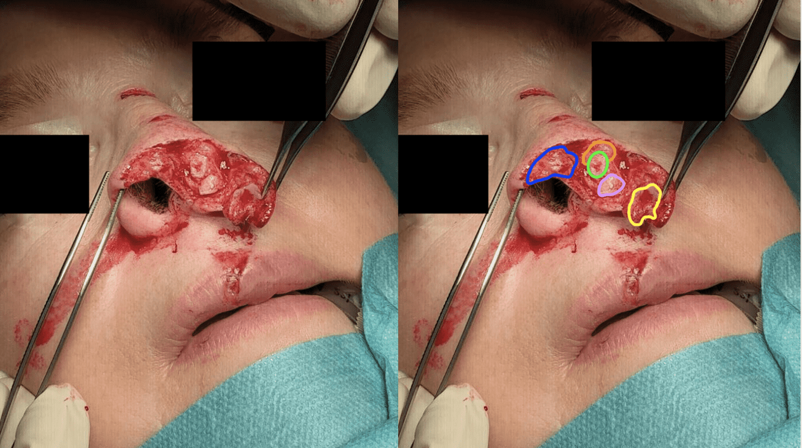 Cartilage reconstruction